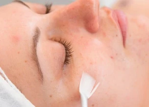 ¿Qué es el peeling químico médico y qué tipos hay?