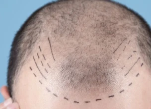 ¿Qué tipos de alopecia existen?